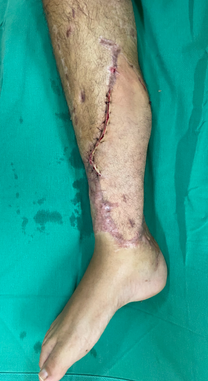 Aspecto final após lipoaspiração