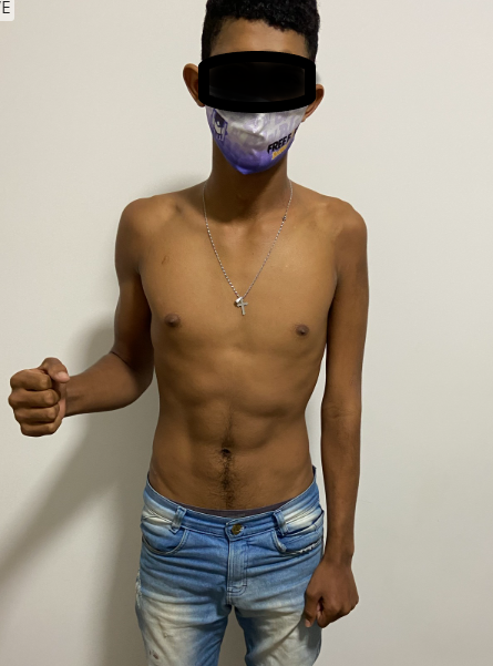 Aspecto clínico — lesão parcial do plexo braquial