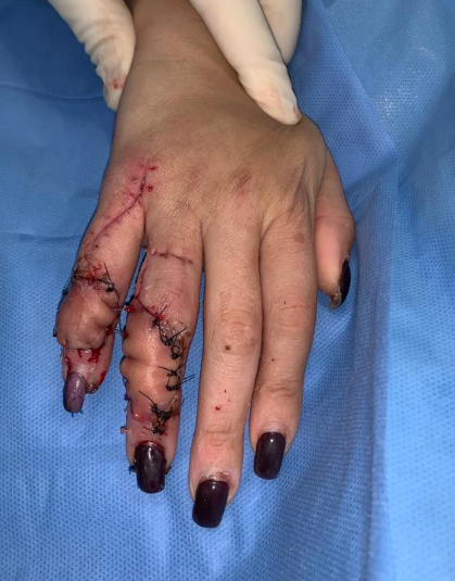 Enxerto tendão extensor pós-operatório 2