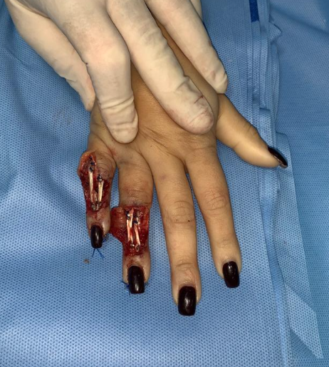 Enxerto tendão extensor pós-operatório
