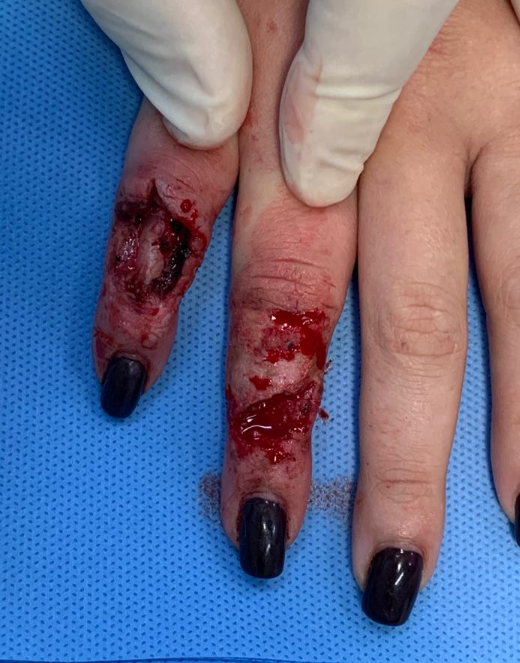 Enxerto tendão extensor pré-operatório