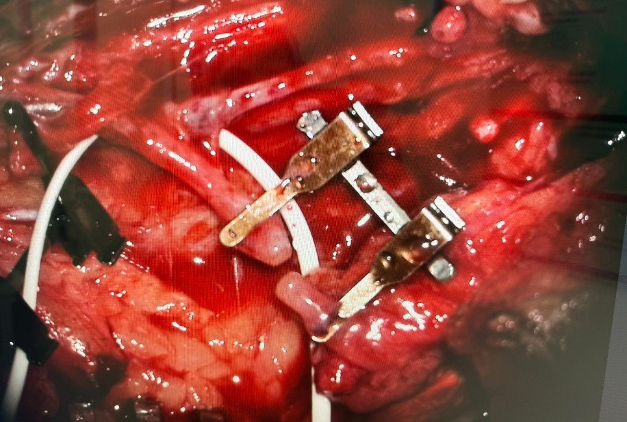 Anastomose vascular microcirúrgica sob microscópio — Dr. Hélio Polido Garcia