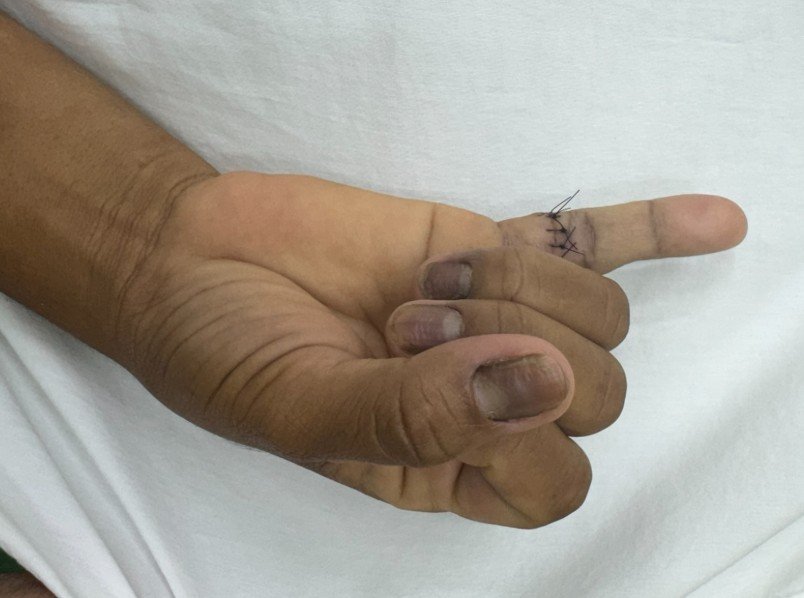 Lesão tendão flexor zona II