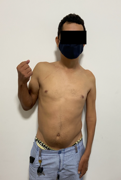 Lesão total do plexo braquial — pré-operatório (1)