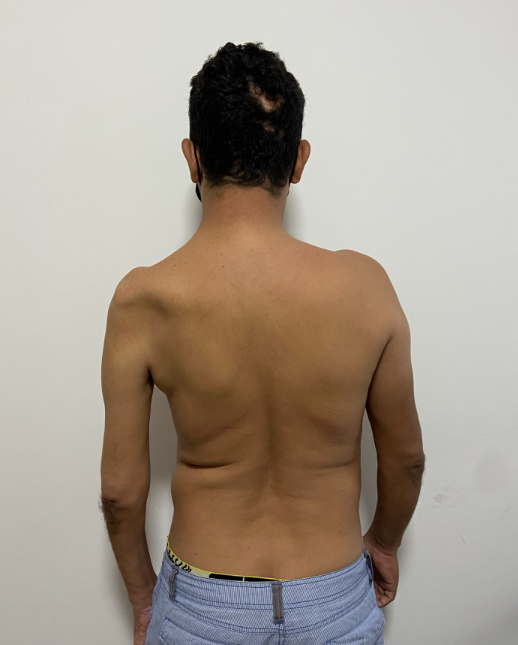 Lesão total do plexo braquial — pré-operatório (2)