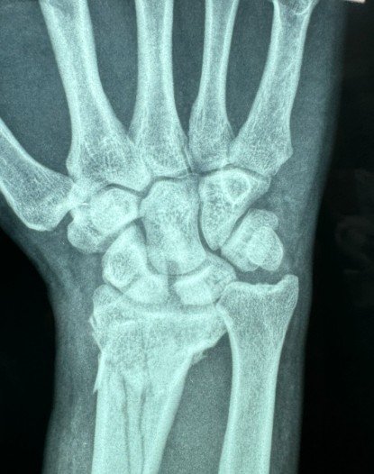 RX fratura punho frente