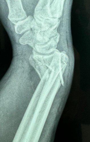 RX fratura punho perfil