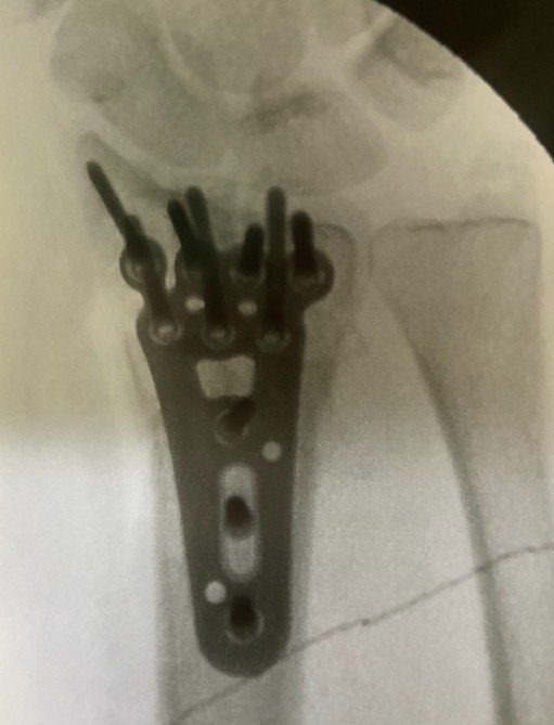 RX placa volar fratura punho