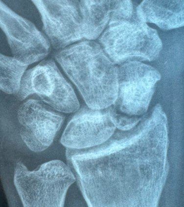 Pseudoartrose do escafoide