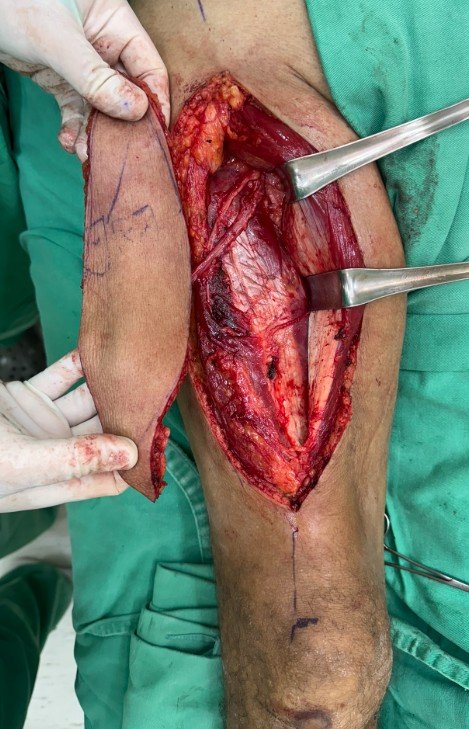 Retalho ALT anterolateral da coxa
