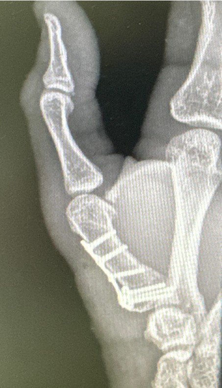 Osteotomia de Extensão do Metacarpo
