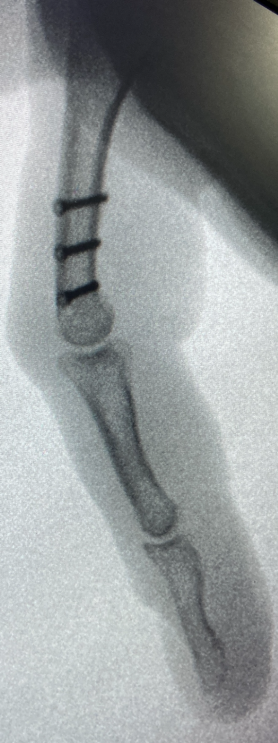 RX falange proximal caso 2