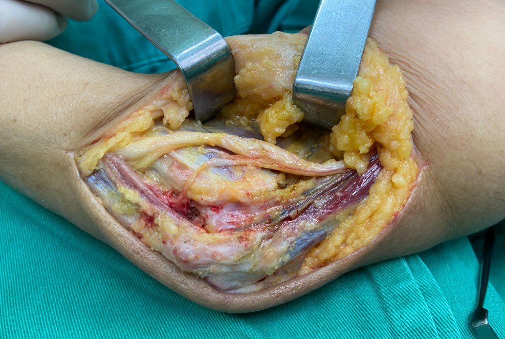 Transposição aberta nervo ulnar