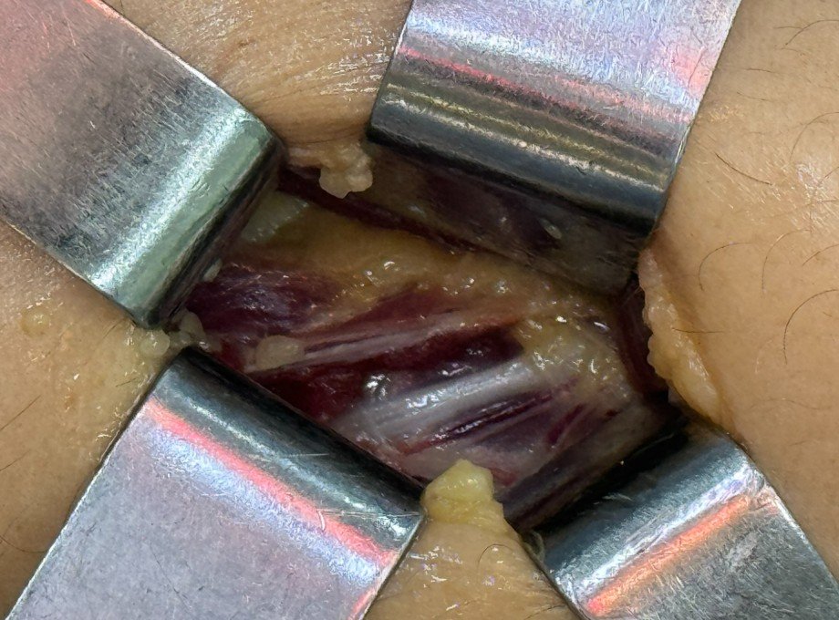 Anatomia nervo interósseo posterior