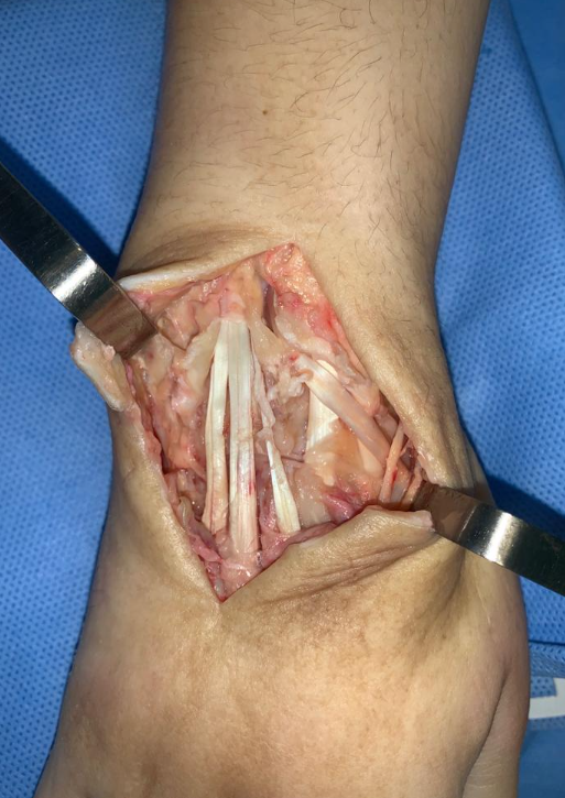 Anatomia tendões extensores