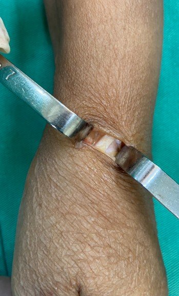 Cirurgia Aberta