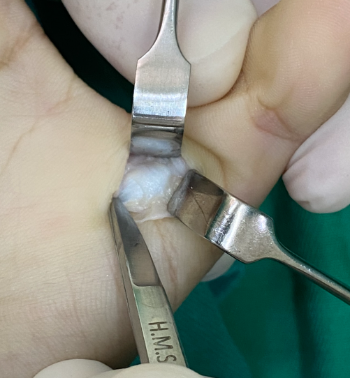 Cirurgia Aberta