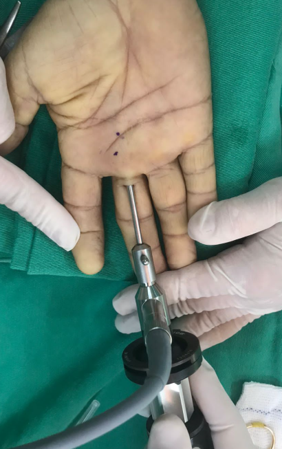 Cirurgia por Endoscopia
