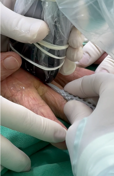 Cirurgia por Ultrassom