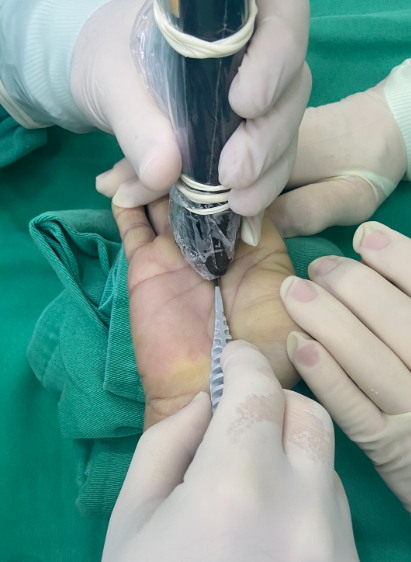 Cirurgia por Ultrassom