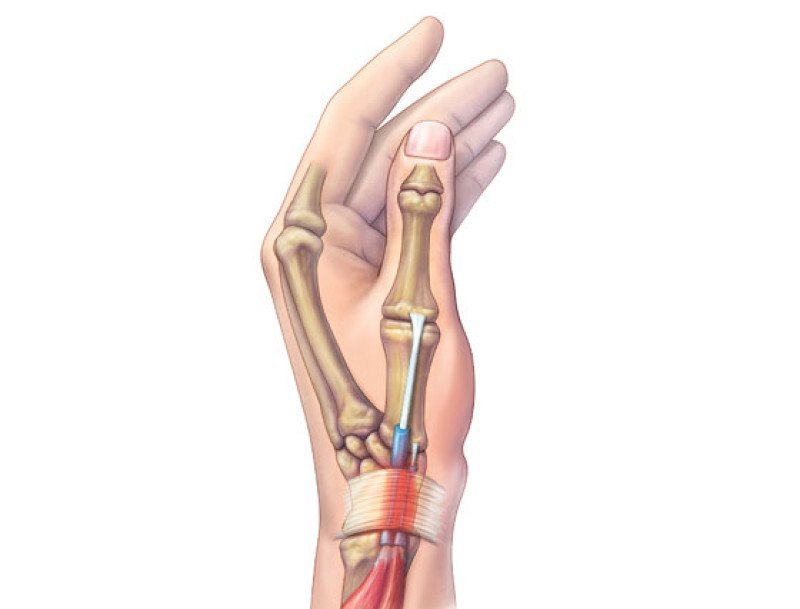 Anatomia — Doença de De Quervain