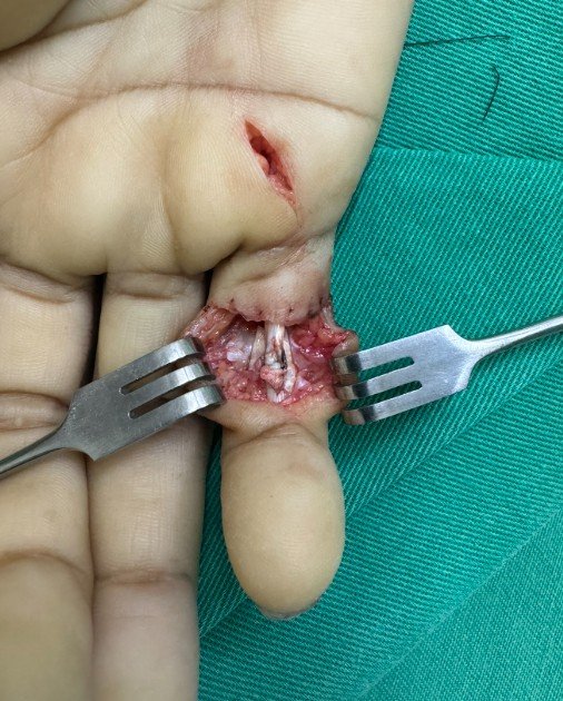 Após reparo tendão flexor zona II
