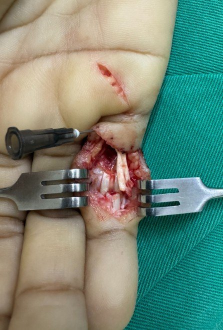 Intraoperatório lesão flexores zona II