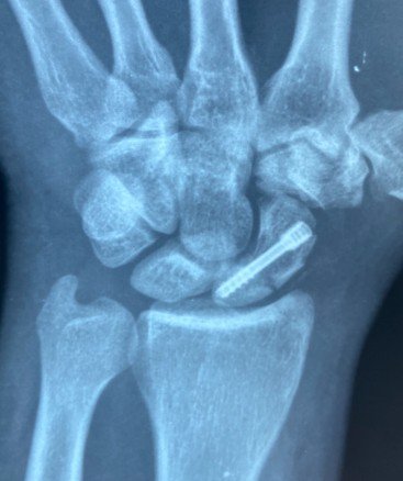 Parafuso escafoide perfil