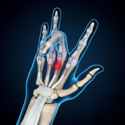 Anatomia do dedo em gatilho — Polia A1