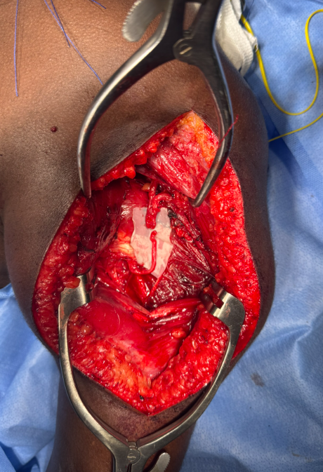 Microcirurgia do plexo braquial
