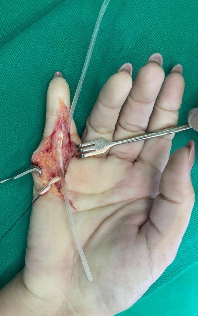 Reconstrução tendão flexor