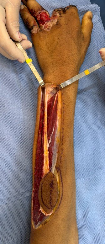 Interóssea posterior 2