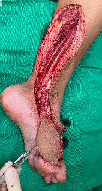 Tibial posterior resultado