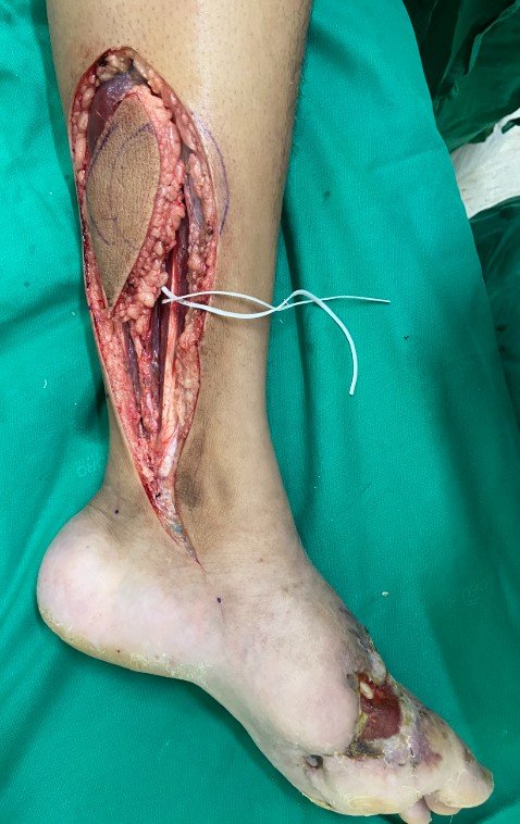 Retalho tibial posterior