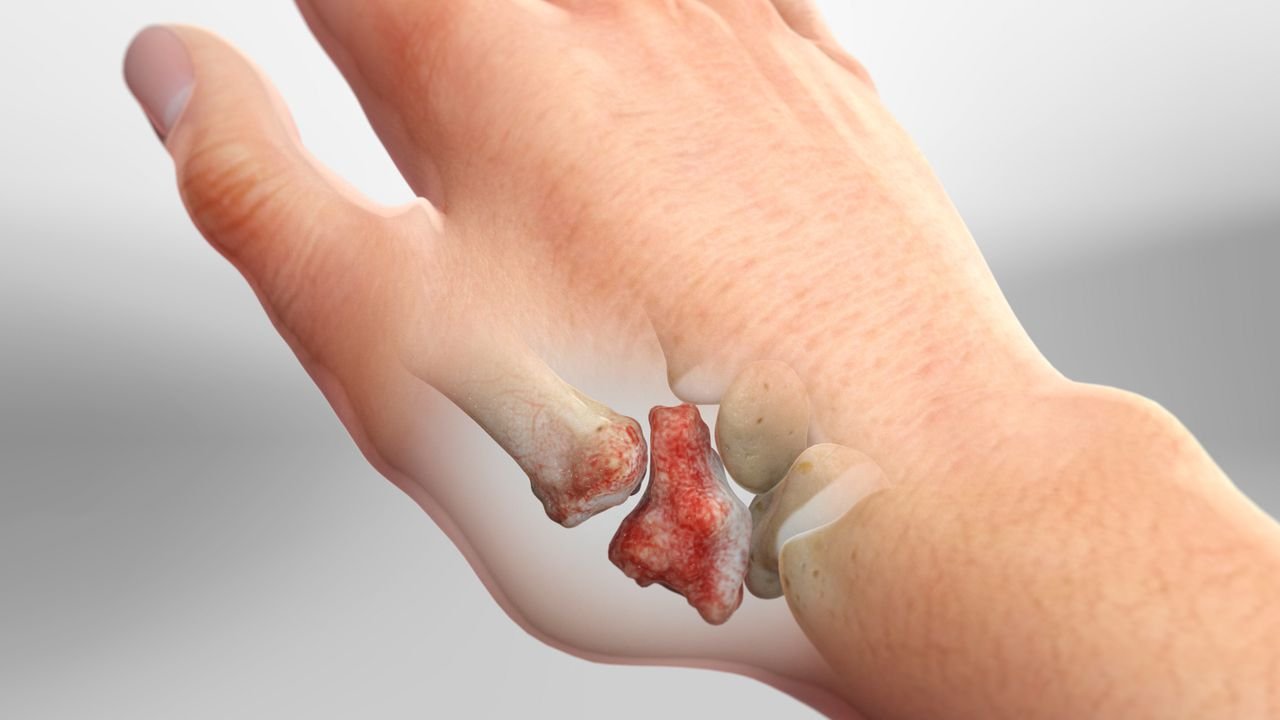 Anatomia da rizartrose — articulação trapézio-metacarpal