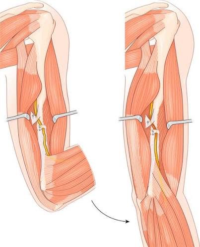 Septo intermuscular lateral