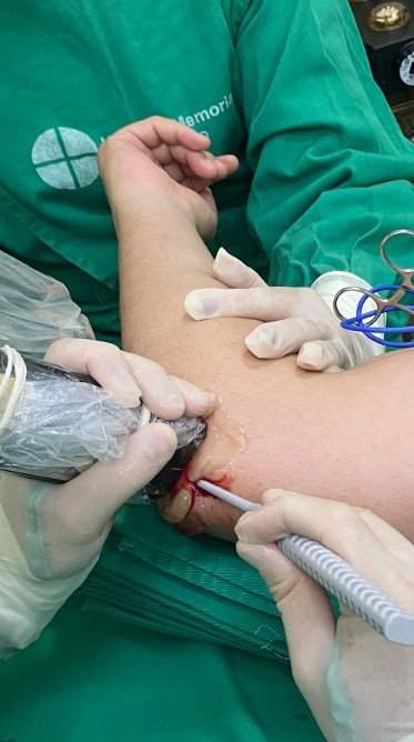 Túnel cubital técnica ecoguiada